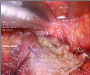 Figure 6 Neck group Ia, Anterior belly digastric muscle (1).