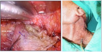 Figure 7 Drain and postoperative sutured wound.