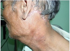 Figure 8 Post operative incision scar of Endoscopic assisted retro auricular neck dissection, after 2 weeks.