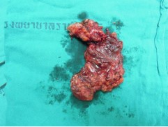 Figure 9 Specimen for Endoscopic assist Retro auricular Selective Neck Dissection I-III.