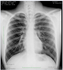 Case one. Standard chest X-ray AP view showing bilateral paramediastinal/paracardiac radioluncent bands. 