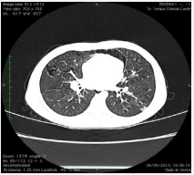 Figure 3 Case two. Chest CT: air infiltrating lung and parahilar interstice