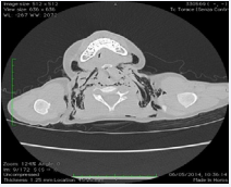 Figure 4 Case two. Chest CT: subcutaneous emphysema with paraclavicular and neck distribution.
