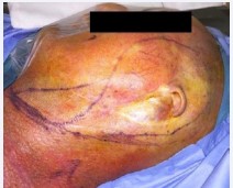 Figure 1 A clinical photograph of the 62-year-old patient with fluctuant swelling to the pinna remnant, this is confirmed as recurrent squamous cell carcinoma.