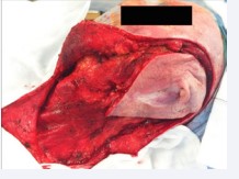 Figure 2 Head and neck component. En bloc resection of the recurrent disease including a radical neck dissection of the left neck.