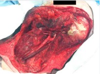 Figure 3 Soft tissue component of the resection now complete which include radical neck dissection, total parotidectomy and excision of the pinna remnant.