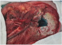 Figure 4 The lateral temporal bone component. Clinical photograph of the operative site following soft tissue excision and subtotal temporal bone resection.