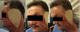 Figure 5 Plastic surgery micro vascular reconstruction and facial reanimation. Patient has undergone an ALT free flap reconstruction followed by a brow lift, mid facial lift, lower lid tarsorraphy with 1.8- gram weight inserted.