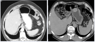 Figure 1 CT of the left hepatic lobe agenesis in 2 patients. A. Axial image of the upper abdomen in a 42-year-old woman reveals an absent left lobe, causing midline position of the stomach and protrusion of the splenic flexure in to the left subphrenic space. B. CT section of the upper abdomen in this 60-year-old man demonstrates a horizontal stomach with adjacent loop of the transverse colon. The absence of left lobe was confirmed at laparotomy for resection of the gastric GIST (arrow)