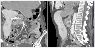 Figure 2 Agenesis of the left lobe complicated by gastric volvulus and its hiatal herniation in a 76-year-old woman. A, B. Coronal, and sagittal images show the right lobe of the liver but no left lobe, with a fluidfilled stomach herniating into the thorax