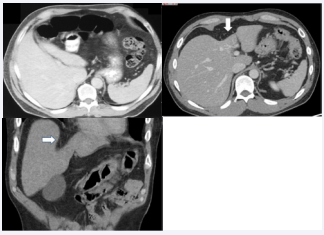 Figure 3 CT features of the left lobe hypoplasia in 2 patients. A. Axial image of the upper abdomen in this 47-year-old man demonstrates the small left lobe due to reduced size of segments 2 and 3, with gasfilled transverse colon occupying the upper abdomen. B and C. Axial and coronal images in this 36- year-old man show a concave defect in the anterior aspect of the liver caused by hypoplasia of segment 4 (arrows).