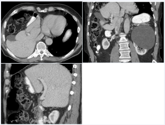 Figure 4 Segmental agenesis of the right hepatic lobe in an 82-yearold man with prostate cancer. A. Axial CT image reveals a deformed configuration of the liver due to the absence of its antero-lateral segments. The ectopic gallbladder and colon are visible in the vacated liver space. B, C. Coronal, and sagittal images show a large defect resulting from agenesis of segments 5-7 of the right lobe, where the gallbladder and hepatic flexure have occupied.