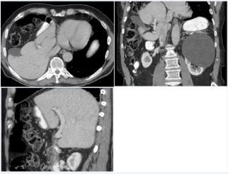 Figure 5 Segmental agenesis of the right lobe in a 74-year-old man. A, B. Axial and coronal CT images show a wedge-shaped defect of the liver caused by agenesis of its segment 8, occupied by the gallbladder and hepatic flexure.