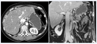 Figure 6 Hypoplasia of the caudate lobe in a 45- year-old woman. A, B. Axial, and coronal images show a small caudate lobe projecting between the portal vein and inferior vena cava (arrows).