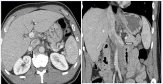 Figure 7 Agenesis of the caudate lobe in a 54-year-old man with duplication of the inferior vena cava. A. Axial CT image reveals the absence of caudate lobe in the space between portal vein (small arrow) and junction of the larger left and smaller right IVC (large arrow). B. Coronal section shows a markedly dilated left IVC that continues through the liver (white arrow).