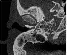 Figure 1 (Patient 1) High-resolution computed tomography (HRCT) of temporal bone (right) showing soft tissue opacification and expansion of mastoid and petrous air cells without any evidence of bony erosion.