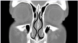 Figure 1 Nasal Septal Swell Body* (NSB) as seen on coronal CT image.