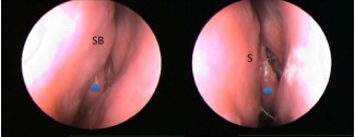Figure 3 Endoscopic view of left nasal cavity showing NSB before and 6 months after RFA. Blue dot on anterior tip of middle turbinate. SB = swell body, S = septum