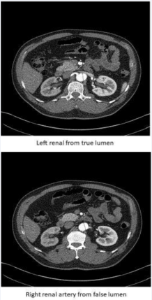 Figure 3 shows a CT angiogram of a case with the left renal artery  from the true lumen (top panel) and the right renal artery from the  false lumen (bottom panel).