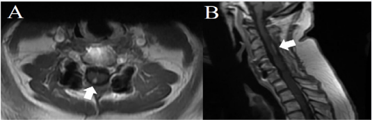 Figure 1 Axial (A) and Sagittal (B) T1 gadolinium enhanced MRI of the spine demonstrating glioma in the right paramedian dorsal aspect of the spinal cord at the level of C3-C5.