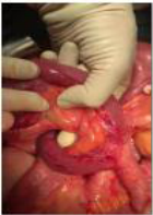 Per operative view demonstrating a technical issue with the confection of Roux-en-Y jejunal loop in extra-hepatic bilio-digestive anastomosis.