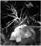 Biliary magnetic resonance imaging demonstrating a nonmodal anatomy: Drainage of the right anterior sectorial duct into the common bile duct 5 mm above the bilio-digestive anastomosis.