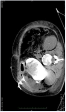 Computed tomography demonstrating the cause of the enterocutaneous fistula.