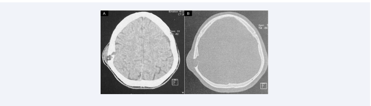  (A) Axial CT scan in soft-tissue window showed an inhomogeneous intradiploic solid mass in the right parietal region with areas of  calcification. (B) Axial CT scan in bone window demonstrated osteolytic changes with erosion of both tables of the vault.