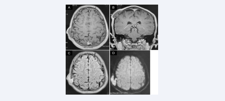 T1 weighted Magnetic Resonance Imaging (MRI), axial view (A) and coronal view (B) showing a hypointense lesion in the right parietal  region without enhancement after gadolinium administration with mild thickening of the dura. FLAIR: Fluid-attenuated inversion recovery (C)  and Diffusion Weighted Imaging (D) showing hyperintense lesion.