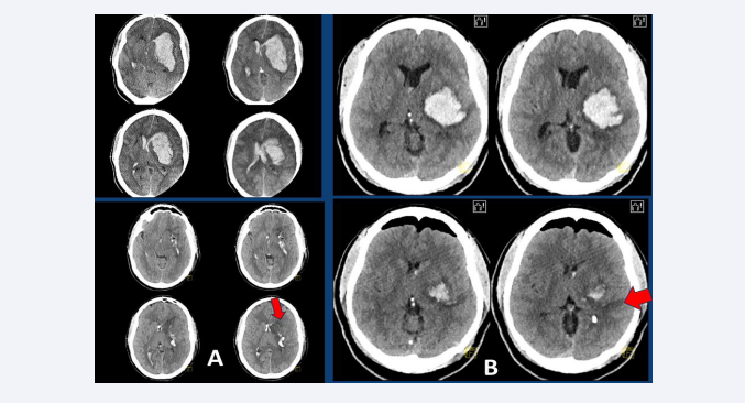(A) Upper left: CT-scan of a 42-year-old patient with an ellipsoidal left DIH of 74 ml volume and bilateral ventricular filling, who is admitted to hospital in  a coma and with a dilated left pupil, after suffering a generalized seizure. Bottom left: Postoperative CT scan showing almost complete evacuation of the clot using  a microscopic MIT frontal approach (red arrow), with additional placement of two ventricular drains. (B) Upper right: CT-scan of a 51-year-old patient with a left  spherical DIH of 56 ml volume, who was admitted to hospital with right hemiparesis and aphasia. Bottom right: Postoperative CT scan showing almost complete  evacuation of the clot performed through an endoscopic temporal approach (red arrow).