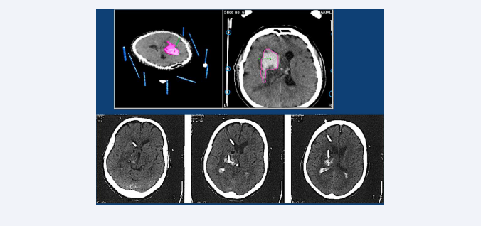  Top row: CT-scan with stereotactic frame of a 55-year-old patient with a right located DIH of 35 ml volume and bilateral partial ventricular filling, who was  admitted to hospital with left hemiparesis and drowsiness. Lower row: Postoperative CT-scan, 24 hours after the first lysis (Actilyse) was performed through the  stereotactic implantation of two catheters. One in the intracerebral clot, and the other in the right ventricle.