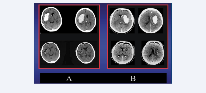 A Left (upper): preoperative CT-scan of a patient with 64 ml DIH on the right side and small intraventricular hemorrhage. Left (lower): Postoperative CT  scan following a right microscopic MIT-frontal approach revealing no residual hematoma. B Right (upper): preoperative CT-scan of a patient with 59 ml DIH on the left  side and small intraventricular hemorrhage. Right (lower): Postoperative CT scan following a left microscopic MIT-frontal approach revealing no residual hematoma.