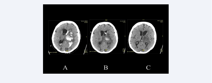 Overweight 50-year-old patient with hypertonic crisis, who as a car driver, had slowly driven into a ditch. She had previously noticed numbness in her  right fingers, then in her right arm and right leg. At the admission to the hospital, she presented a hemiparesis and aphasia. The CT scan upon admission to the  hospital (A) shows a thalamic bleeding of about 30 ml, with clot fragmentation and significant left intraventricular bleeding. In this CT-scan can also be observed  various hypodensities, which confirm a more diffuse cerebrovascular disease. The CT-scan two weeks later (B) shows a reduction in intraventricular bleeding, which  was treated only with a drainage. After more than two weeks and having also been treated with a lumbar drainage, the control CT-scan (C) shows the absence of  hydrocephalus and the residual clot in the process of resorption. The patient was shortly after referred to a rehabilitation clinic.