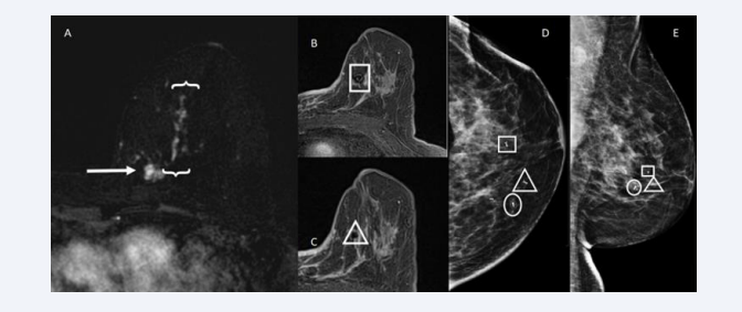  A: T1-weighted post-contrast subtraction MRI shows a lobular mass with irregular margins in the left breast upper inner quadrant (arrow). This finding is  consistent with the index carcinoma. There is associated malignant appearing segmental, reticular non mass enhancement contiguous with the index mass extending  anteriorly and laterally (brackets). B and C: Post-contrast MRI show clip marker placement in the anterior-superior (square) and lateral (triangle) most extent of  enhancement. D and E: Craniocaudal and lateral post-clip mammography shows the index tumour (circle) and two ribbon clip markers delineating the anterior (triangle  and square) and lateral (square) most extent of disease. Final pathology showed invasive and in situ ductal carcinoma with negative margins.