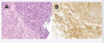 Histopathological analysis of the prostate needle biopsy in Case 2 at  diagnosis.