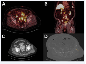 PSMA-PET-scan and CT-scan imaging in Case 2.