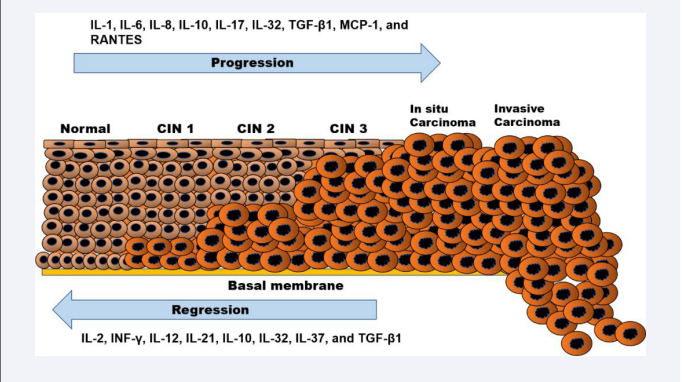 Effect of cytokines on the progression of cervical neoplasia. In general, cytokines have the effects of slowing or preventing the  progression of the neoplasm, inducing its progression, or having a dual effect according to the circumstances. Cytokines that prevent progression  of the malignancy include: IL-2, INF-?, IL-12, IL-21, IL-10, IL-32, IL-37, and TGF-?1; those that induce progression: IL-1, IL-6, IL-8, IL-10, IL-17,  IL-32, TGF-?1, MCP-1, and RANTES; and those that may have a dual effect: IL-10, IL-32, and TGF-?1.
