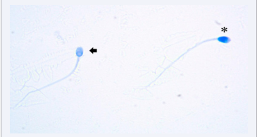 Sperms stained with or without staining of acidic aniline blue stain  are evaluated as negative (-), and dark blue stained sperms are evaluated as  positive (+) and show maturation defect. (100x immersion lens with light  microscope image) Arrow AB negative, * AB positive.