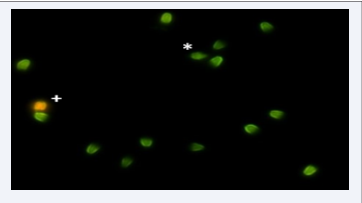 Acridin orange staining A) shows that there is no DNA fragmentation  in the sperms displayed as green (normal), B) shows DNA fragmentation in  the sperms displayed as yellow or orange (damaged). (100 x immersion lens  fluorescent microscopy image). 