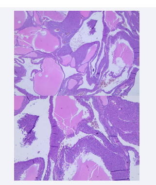 (Figure 2 images A & B) On histology, the tumor lacked a  well-formed capsule at the periphery and demonstrated uniform  microscopic features with solid areas composed of sheets of  eosinophilic cells, admixed with variably sized macro and microcysts.