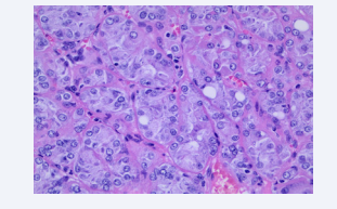 The cysts were lined by cells exhibiting hobnail arrangement  with voluminous eosinophilic cytoplasm. The cells in the solid areas  typically showed diffuse and compact acinar or nested growth. Focal  small aggregates of histocytes and lymphocytes were seen. The  tumor cells showed abundant eosinophilic cytoplasm with prominent  granular basophilic cytoplasmic stippling and round to oval, often  irregular nuclei, with focally prominent nucleoli (equivalent to ISUP  nucleolar grade 3).