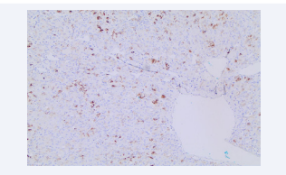 Immunohistochemistry showed positive patchy expression  for CK20 (Image 5) and CK7. The tumor was negative for CD117,  TFE3, and CA9. SDH (succinate dehydrogenase) and FH (fumarate  hydratase) expression were intact.