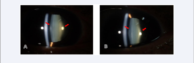 Slit-lamp examination of the right eye (A) and left eye (B) showing the posterior lenticonus (red arrows)..