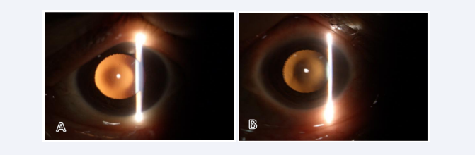 Oil-droplet reflex in right (A) and left (B) eyes