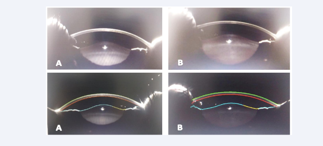 Anterior segment scan using a scheimpflug camera reveals Right (A) & Left (B) anterior and posterior lenticular bulges.