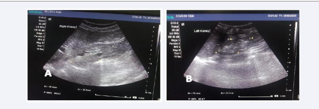 Transabdominal ultrasonography reveals Right (A) & Left (B) renal small size with poor corticomedullary differentiation.
