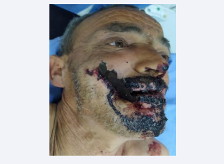A 54-year-old man with a big Fragment of the cut-off wheel  protruding on his face.
