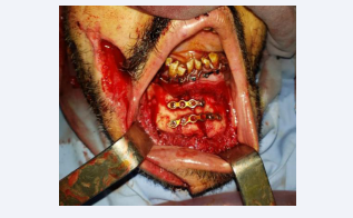 Open reduction of the mandibular fracture using two titanuim  manipulates.