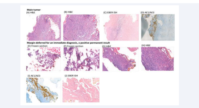 A 48-year-old female had residual NPC after chemoradiotherapy. The permanent pathology of excised tumor from nasopharyngectomy  revealed a non-keratinizing carcinoma, with positive of AE1/AE3 IHC staining, and ISH stain for EBER (A-D). Immediate diagnosis was deferred for  ione of the resection margins: the frozen sections showed atypical cells with inflammatory cell infiltration in a fibrotic background. Those cells were  confirmed to be malignant with the assistance of ancillary studies of IHC and ISH staining (E-J).