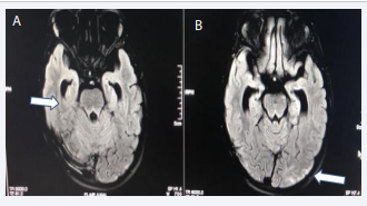 MRI Flair images showing. A) Dilated lateral ventricles and  B) Hyper intensities in parieto-occipital cortex.